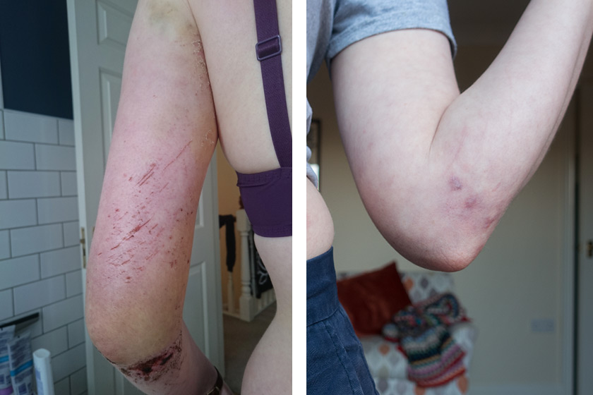 Arm injury