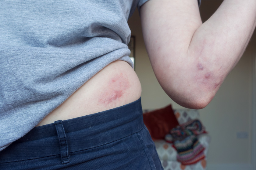 Hip and elbow scars